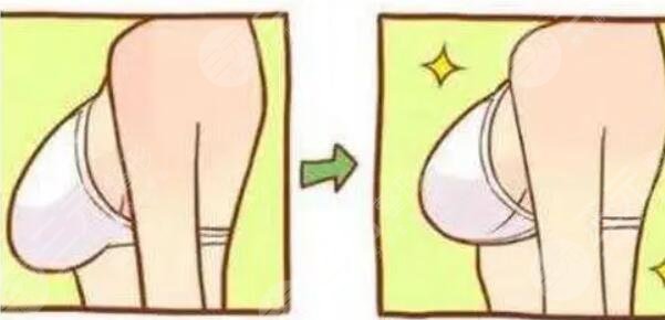 乳房懸吊術會留疤嗎？疤痕嗎？一般在哪個位置？手術效果可以維持多久？