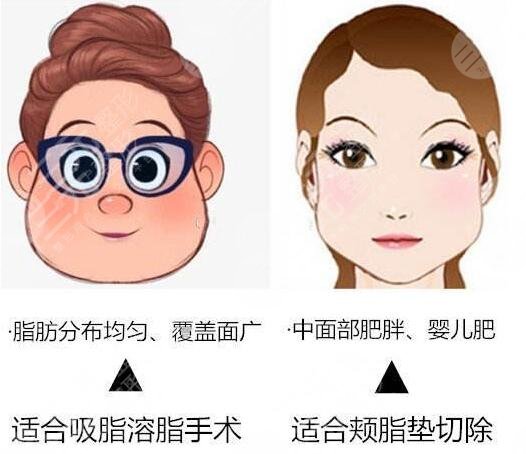 去頰脂墊后遺癥可能有哪些?