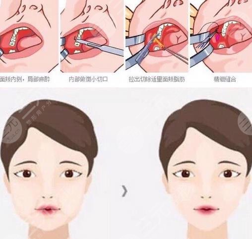 去頰脂墊的原理?是什么?