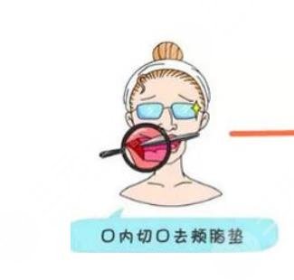 去頰脂墊的原理?是什么?