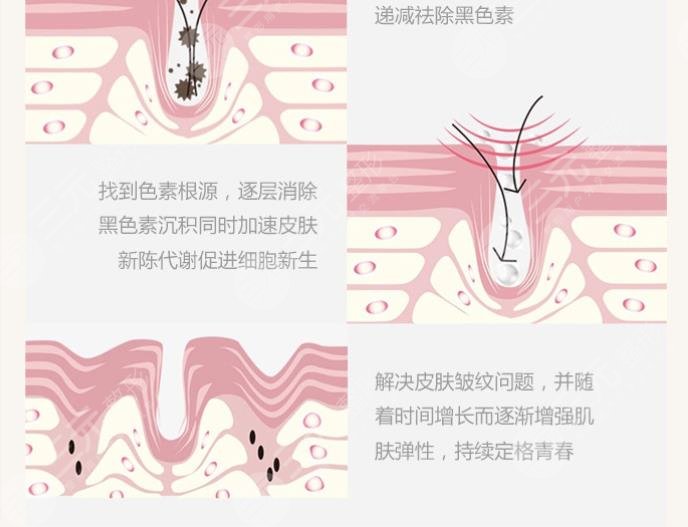 激光除皺|緩解魚?尾紋的原理是什么?
