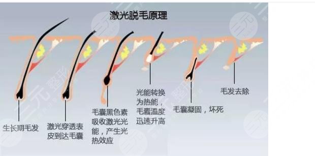 激光脫毛多長(zhǎng)時(shí)?間一次?
