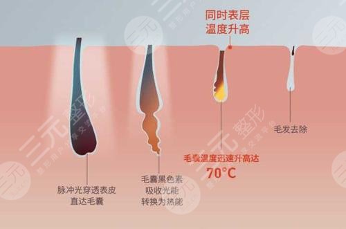 激光脫毛多長(zhǎng)時(shí)?間一次?