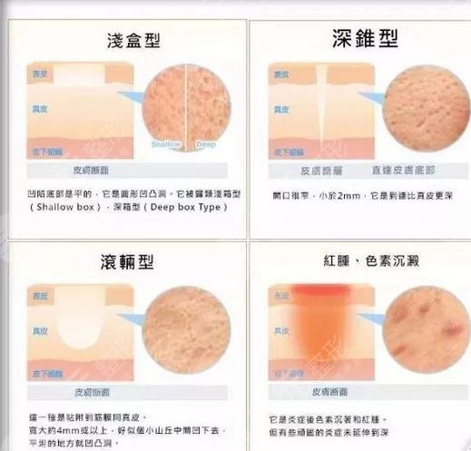 疤痕疙瘩的緩解技巧揭秘
