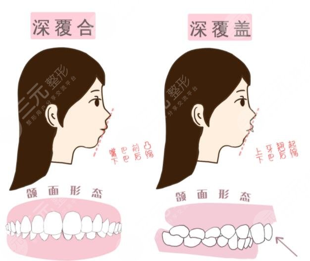 深覆合的矯正年齡是多少?