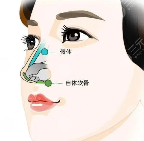 膨體材料隆鼻多少錢2023新版，手術(shù)材料的優(yōu)缺點解析、術(shù)后護(hù)理小貼士~