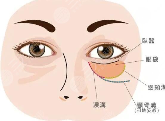 長眼袋怎么消除?