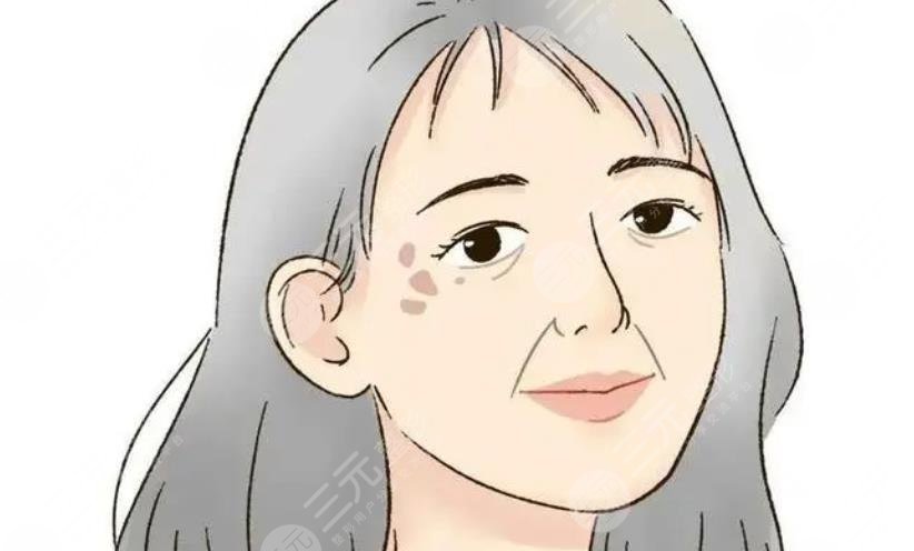臉上長老年斑的原因是什么?