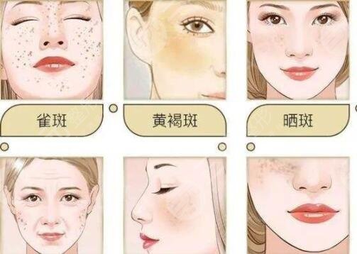 激光祛斑注意什么?