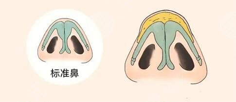 假體隆鼻手術(shù)過程