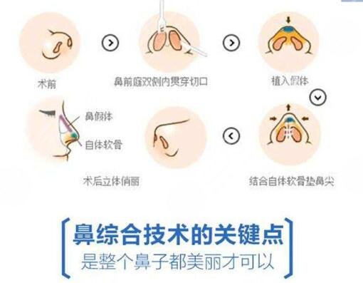 假體隆鼻手術(shù)過程要很久嗎?