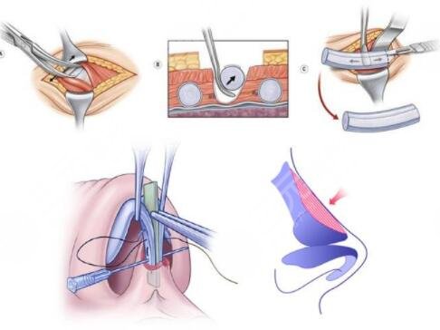 假體隆鼻手術(shù)過程要很久嗎?