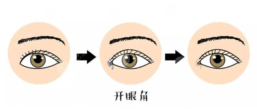 開(kāi)眼角是怎么開(kāi)的?