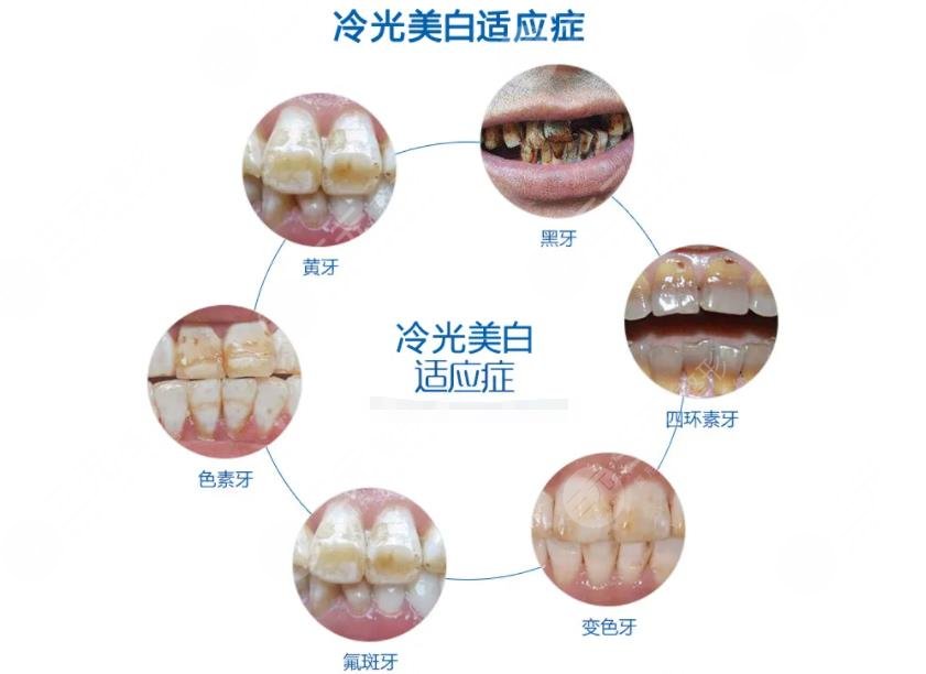 超聲波潔牙要多少錢一次?