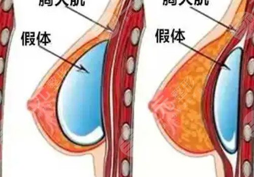妙桃琴面假體隆胸的效果