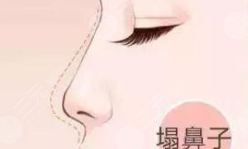 奧美定隆鼻有什么副作用？