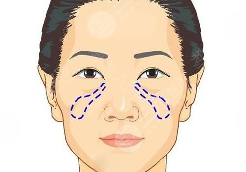 蘋果肌斷層是什么原因？