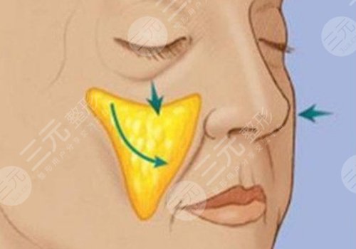 蘋果肌斷層是什么原因？