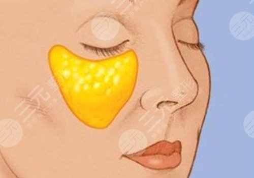 蘋果肌斷層是什么原因？