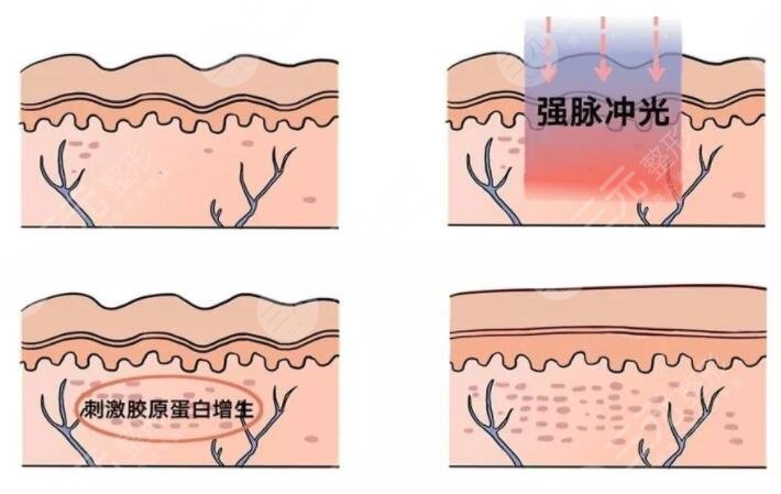 鐳射激光嫩膚需要間隔多長時間一次?