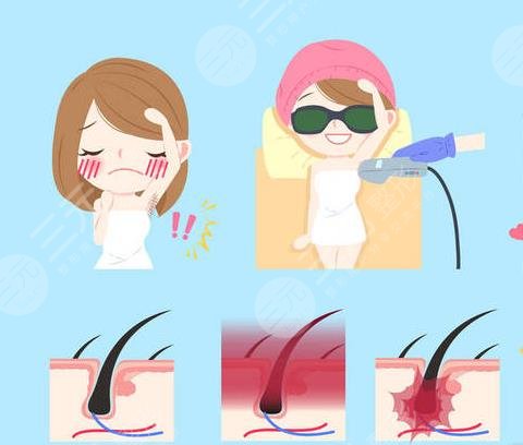 冰點(diǎn)脫毛的具體價(jià)?格曝光