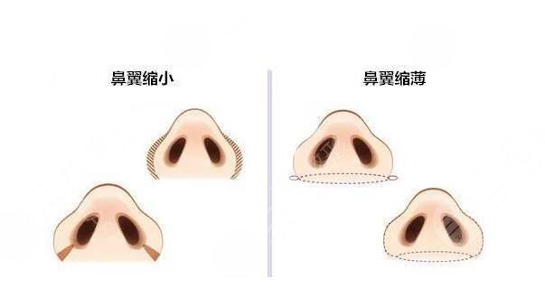 鼻頭縮小手術(shù)的?費(fèi)用大概是多少啊?