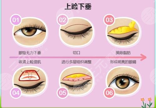 割雙眼皮開眼角如何避免術(shù)后留疤