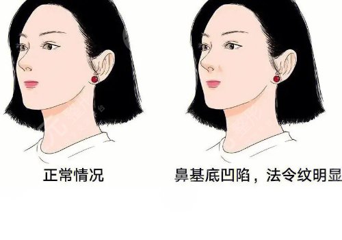 鼻基底填充用什么材料比較好？