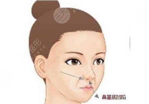 鼻基底填充用什么材料比較好？