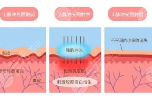 深藍射頻多久做一次?