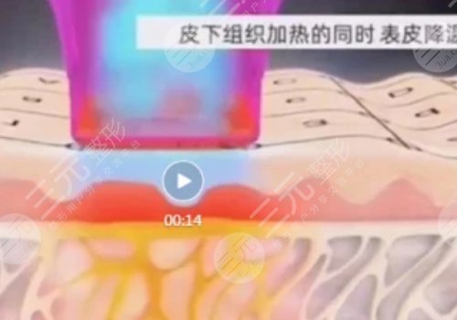 熱瑪吉全臉做一次多少錢？