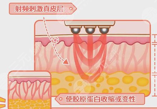熱瑪吉全臉做一次多少錢？