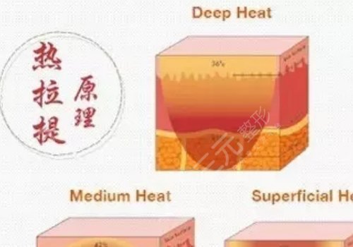 深藍(lán)射頻和熱拉提哪個(gè)好？