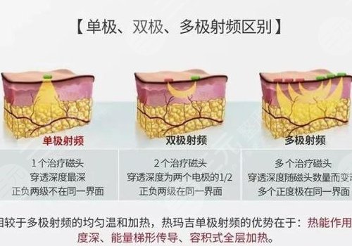 深藍(lán)射頻和熱瑪吉的區(qū)別有哪些？