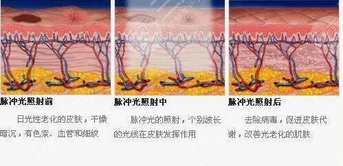 鐳射激光嫩膚后會反黑怎么辦?
