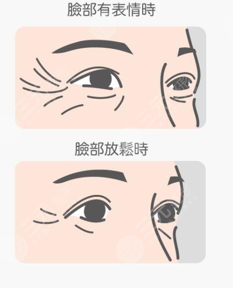 激光去魚(yú)尾紋徹底嗎?