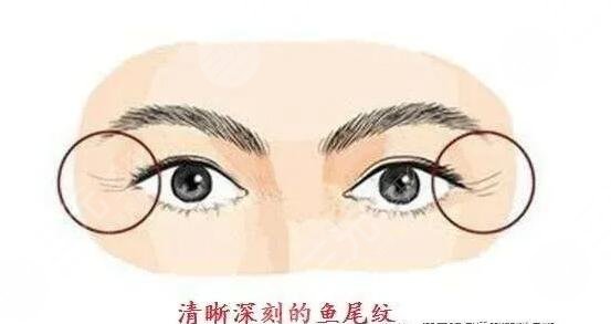 激光去魚(yú)尾紋徹底嗎?