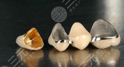 鈦合金烤瓷牙套價(jià)格多少錢(qián)一顆2023？
