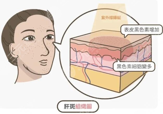 彩光祛斑的費用一般多少錢左右?