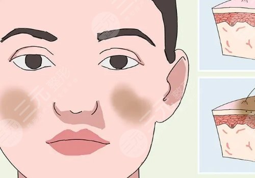 光子嫩膚祛斑會反彈嗎