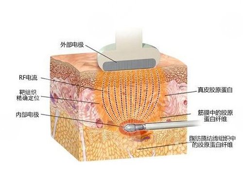 鐳射溶脂有效果嗎？