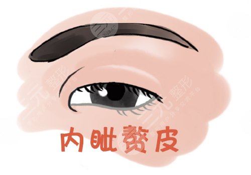 開內(nèi)眼角一般多少錢？