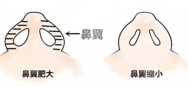 影響鼻翼縮小手術(shù)價格因素有哪些?