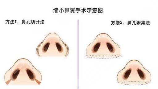 鼻翼縮小手術(shù)風(fēng)險大嗎?