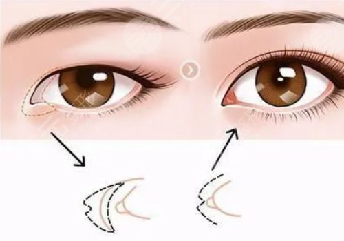 一般開內(nèi)眼角多少錢?