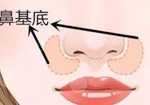 鼻基底注射玻尿酸會(huì)移位嗎？