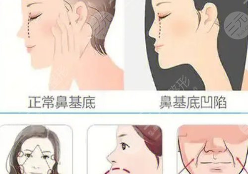鼻基底注射玻尿酸會(huì)移位嗎？