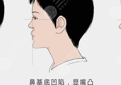 鼻基底注射玻尿酸會(huì)移位嗎？