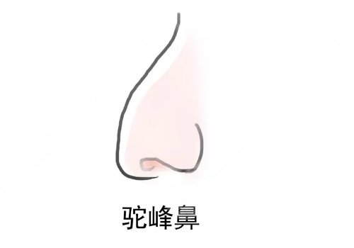 駝峰鼻矯正手術(shù)多少錢？