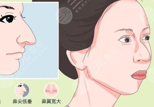 駝峰鼻矯正手術(shù)多少錢？